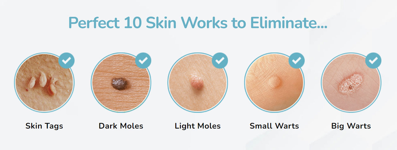 Perfect 10 Skin Tag Remover Reviews