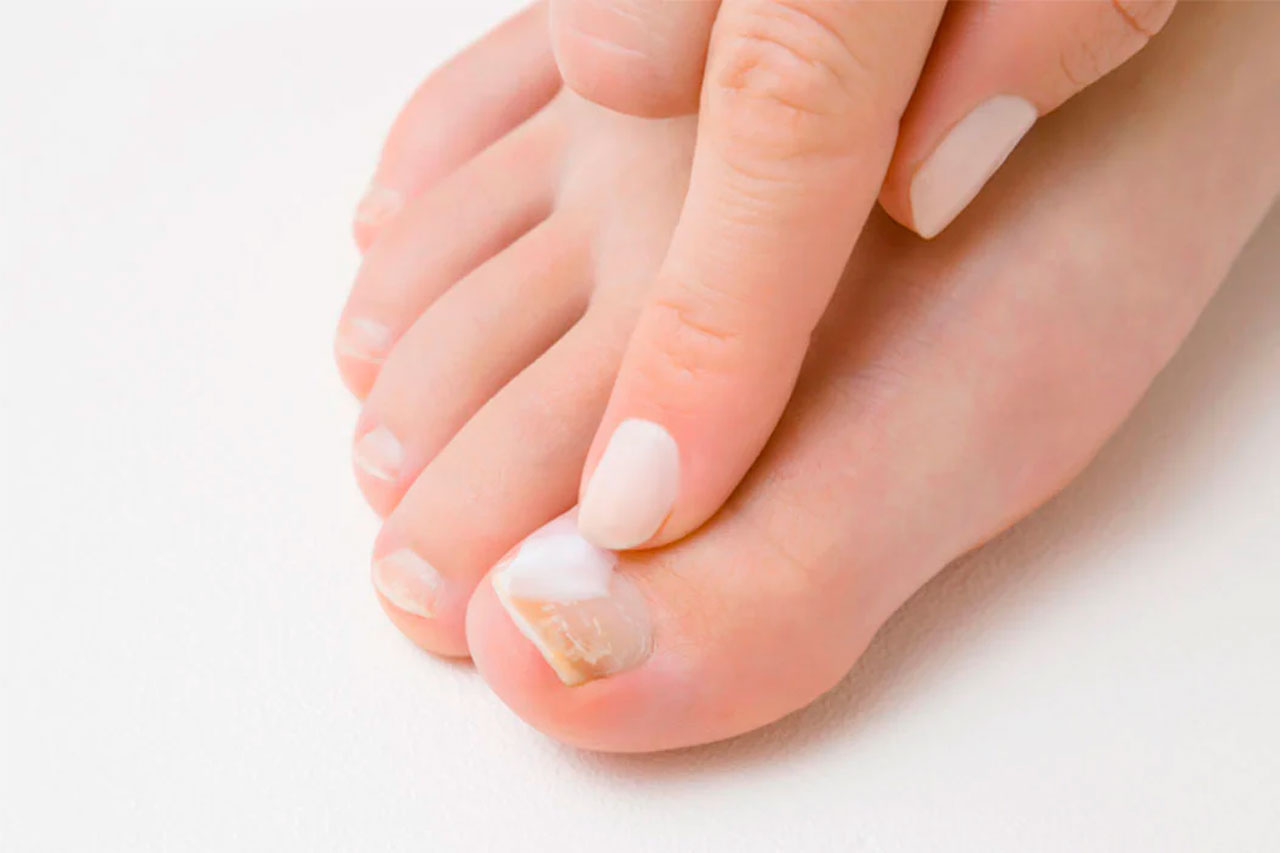 best toenail fungus supplements